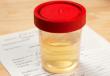 Kaj pomeni beljakovina v testu urina in kako nevarno je njeno povečanje?