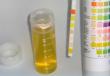 Ploščati epitelij v preiskavah urina pri nosečnicah Kaj kaže ledvični epitelij?