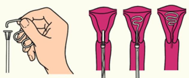 Что такое спираль у женщин. Плюсы и минусы внутриматочной спирали от беременности