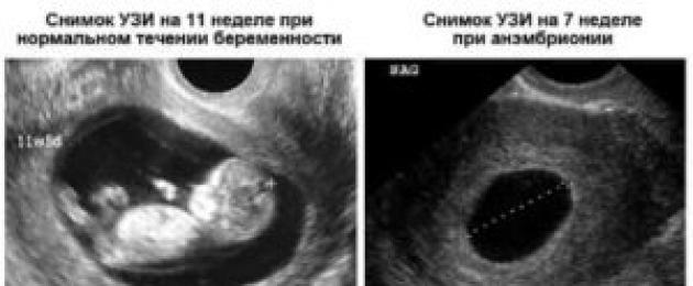 ადრეულ ეტაპზე გაყინული ორსულობის მიზეზები, ნაყოფის გაქრობის ნიშნები, მკურნალობა და შედეგები.  გაყინული ორსულობა: ნიშნები და სიმპტომები გაყინული ორსულობის პროცენტი 20 კვირის შემდეგ