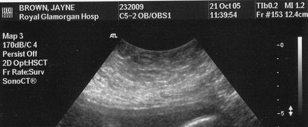 Koliko mesecev je ultrazvok.  Dodatne študije na zadnjem ultrazvoku