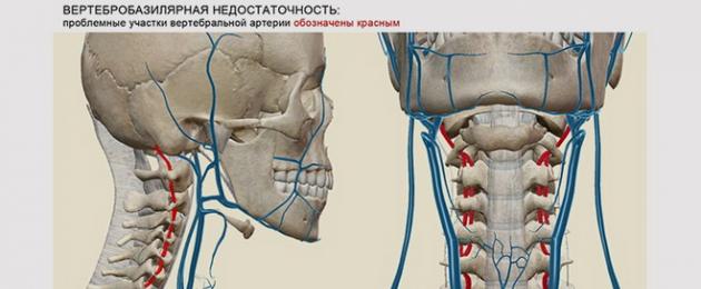 Инсульт в бассейне правой сма. Обширный ишемический инсульт в бассейне левой сма